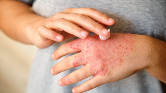 Imagen de dermatitis atópica